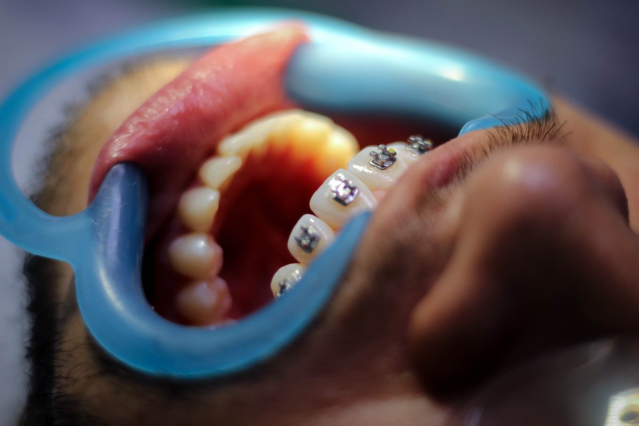 Que penser de l’orthodontie invisible pour adolescent à Paris ?